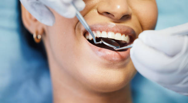 Best Knocked-Out Tooth (Avulsed Tooth) Treatment in Rogue River, OR